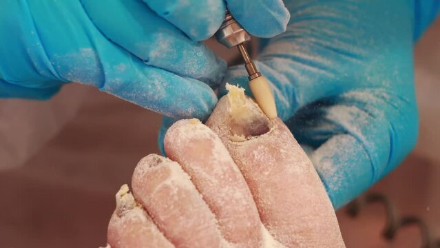 The work of a podiatrist is caring for toenails in an elderly person. nail disease. Hyperkeratosis and keratinized skin, close-up. Slow motion