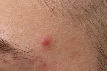 Young man with acne problem, closeup view