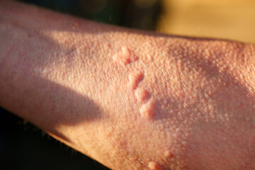 The skin's reaction to nettle is urticaria. Red, severely itchy rashes appear. 