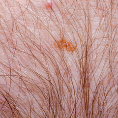 Nevus or mole on the human body close-up. Skin cancer, keratosis or melanoma on the skin.