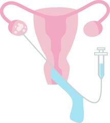 OPU Ovum Pick Up vector illustration. Perfect for presenting anything about reproduction, insemination or ivf.