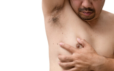 Close up the skin tags on man's skin under the armpits and sides of the body - obrazy, fototapety, plakaty