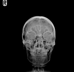 x ray of skull
