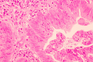 Backgrounds of human cells tissue of lung human under the microscope in pathology lab.View in microscopic of ductal cell carcinoma, adenonocarcinoma from human breast cancer, tissue section by H and E