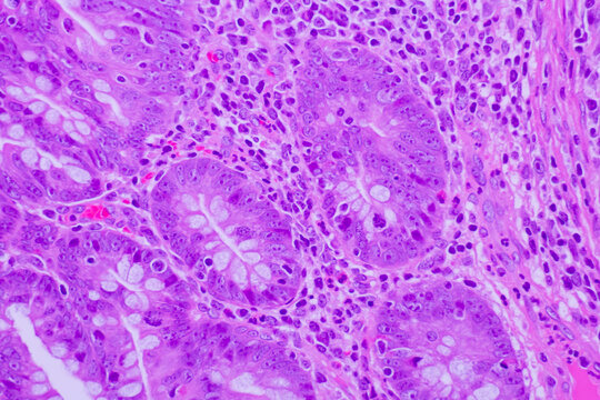 Backgrounds of human cells tissue of lung human under the microscope in pathology lab.View in microscopic of ductal cell carcinoma, adenonocarcinoma from cancer, tissue section by H and E stain.