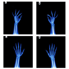 X-Ray Hands ( front view ) : Normal human hands