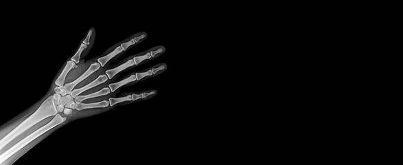 X-Ray Hands ( front view ) : Normal human hands
