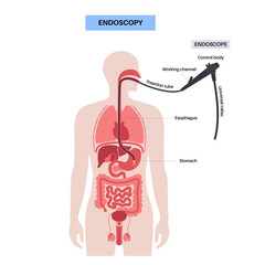 Gastroscopy endoscopy procedure - 614290193