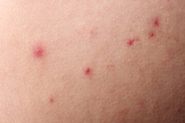 Young person with acne problem, closeup view of skin