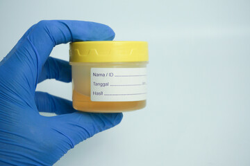 Hand holding urine sample container for medical urinalysis. Urine analysis in the laboratory....