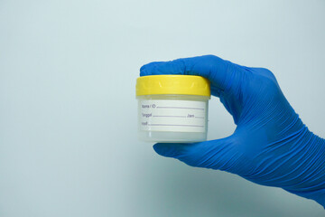 Hand holding urine sample container for medical urinalysis. Urine analysis in the laboratory....