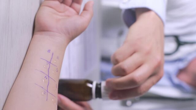 Verticar video of Allergist conducts a prik allergy test, Allergic reactions concept
