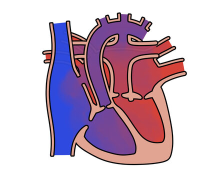完全大血管転移