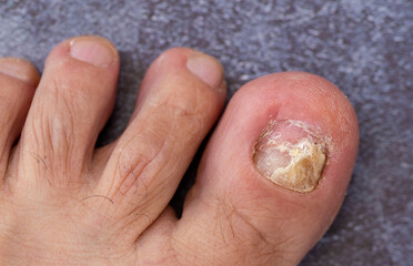 A toenail fungus at the peak of the infection.