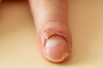 Inflammation of the finger. Managing Finger Inflammation.