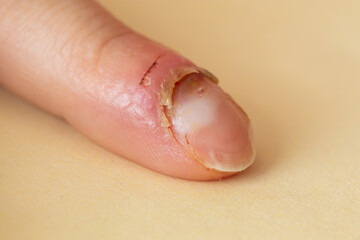 Inflammation of the finger. Managing Finger Inflammation.