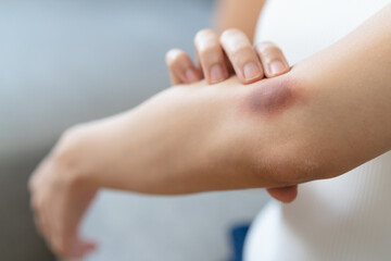 Close-up purple bruised on the arm of human from accident.