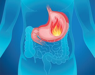 Unhealthy stomach. Gastric ulcers, gastritis. Gastroesophageal reflux disease. Peptic ulcer disease. Digestive system. Humans' anatomical structure. Medical illustration, vector illustration. - obrazy, fototapety, plakaty