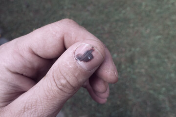 Bruised thumb, black bruise from a hammer