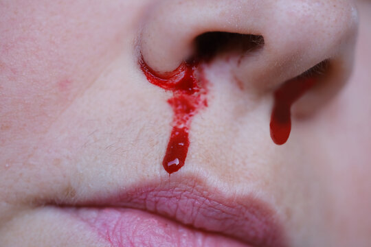 bright red blood flows from nostril, bright red blood flows from nostril, stop bleeding, epistaxis, close-up part of face, fragility of blood vessels, sharp increase in blood pressure