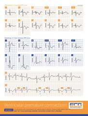 A 4-year-old boy with a clinical diagnosis of long QT syndrome. No genetic testing was done during hospitalization. Holter captured complex ventricular arrhythmias. He died of sudden death.
