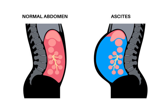 Ascites disease poster