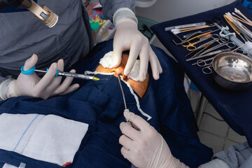 A cosmetic surgeon gets ready to injects local anesthesia just below the bridge of the nose to numb the area prior to an open rhinoplasty procedure.
