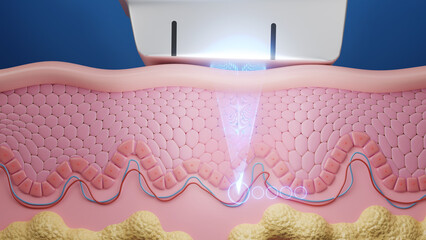Ultherapy hifu laser treatment shot skin to SMAS layer. Saggy skin treatment. 3D rendering.