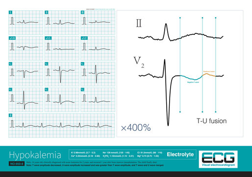 A 14-year-old boy with leukemia developed recurrent ventricular arrhythmias and electrolyte disturbances during hospitalization, and eventually died during hospitalization.
