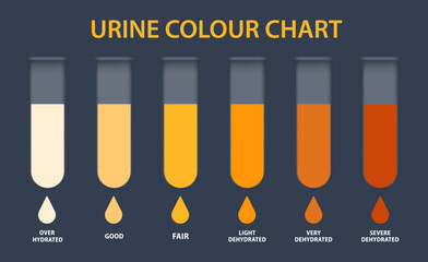 Urine colour chart. Hydration and dehydration level diagram. Medical urinal test kit for urinary tract infection research. Containers with yellow to brown pee for urinalysis. Vector illustration - obrazy, fototapety, plakaty