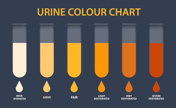 Urine colour chart. Hydration and dehydration level diagram. Medical urinal test kit for urinary tract infection research. Containers with yellow to brown pee for urinalysis. Vector illustration