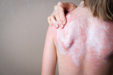 sunburn, red skin of the child's back, hand lubricates inflamed skin with a soothing cream, copy space
