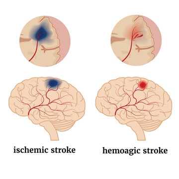 Infographics with types of brain strokes. Medical poster. Vector illustration