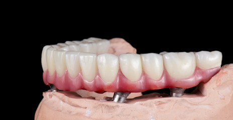 Emax ceramics on hybrid implant bridge