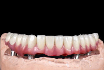Emax ceramics on hybrid implant bridge