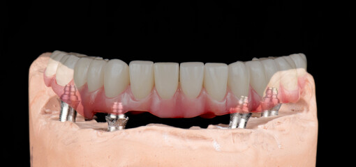 Emax ceramics on hybrid implant bridge