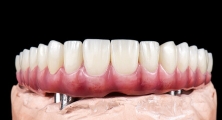 Emax ceramics on hybrid implant bridge