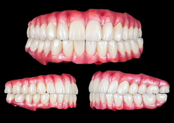 Emax ceramics on hybrid implant bridge