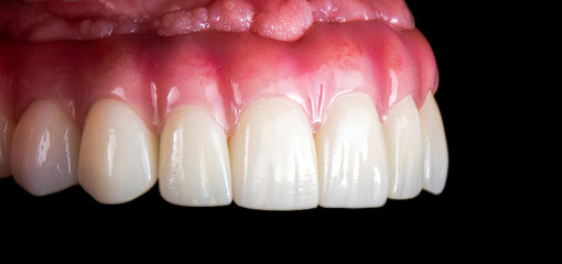 Emax ceramics on hybrid implant bridge