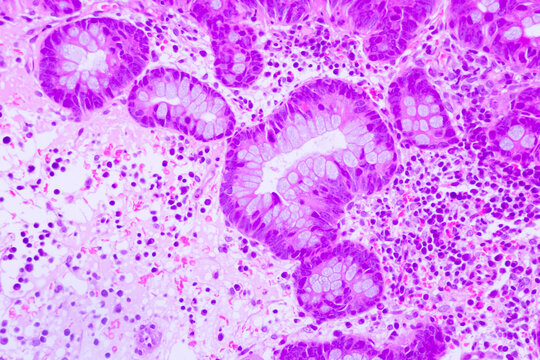 Backgrounds of human cells tissue of lung human under the microscope in pathology lab.View in microscopic of ductal cell carcinoma, adenonocarcinoma from human breast cancer, tissue section by H and E