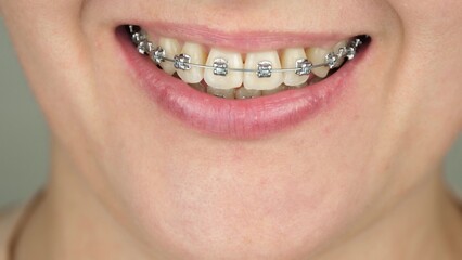 Close-up of a smile with metal braces on the teeth. Bite correction and dental health. Orthodontic treatment. Part of the face close-up