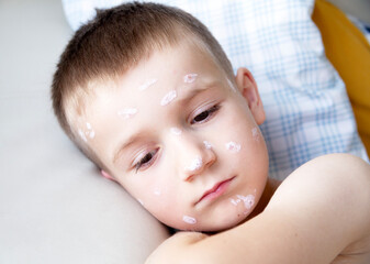 a sad boy of European appearance. The boy has chicken pox. His face is smeared with antibacterial...