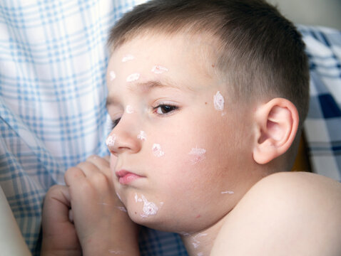 a boy of European appearance lies on a bed. The boy has chicken pox. His face is smeared with calamine
