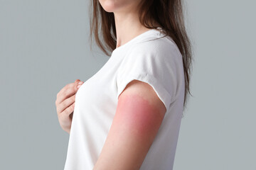 Allergic young woman with sunburned skin on grey background, closeup