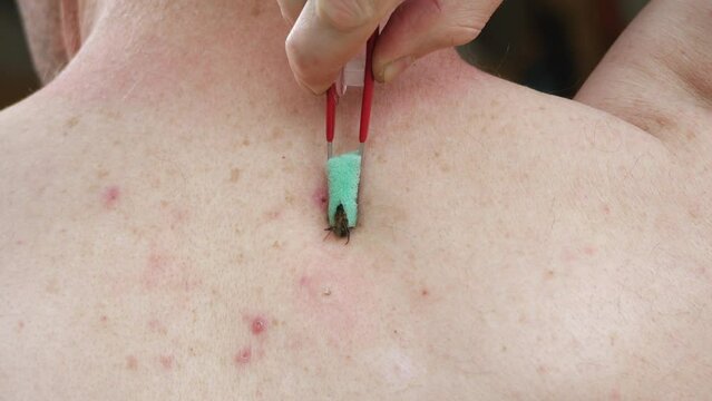 Apitherapy. With the help of tweezers, the bee is placed on the skin of a person and deliberately forced to sting. Bee stings for health and healing. Treatment of arthritis with bee venom