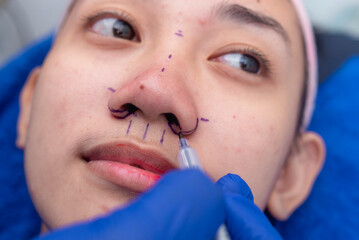 A cosmetic surgeon drawing lines on the alars of a pateint's nose before alarplasty and rhinoplasty procedures. Marking the portions of tissue to be cut off.