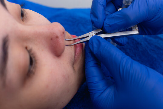 A cosmetic surgeon uses a dental gauge caliper to measure the columella of a patient's nose. Preoperative procedure before rhinoplasty.