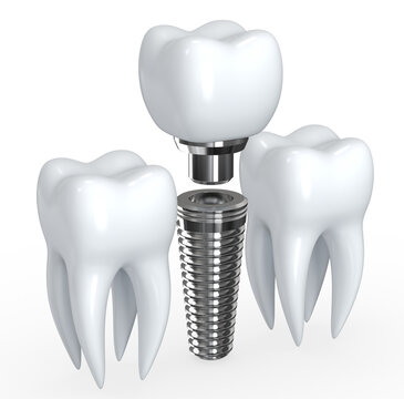 white Tooth Implant. Implant cut and healthy tooth or dental surgery. 