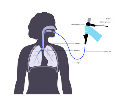 Bronchoscopy procedure concept