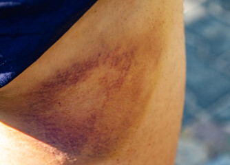 painless bruise on thigh trauma